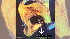Defect septal atrial închis intervențional, fără chirurgie, cu recuperare rapidă, sub coordonarea Dr. Iulian Călin